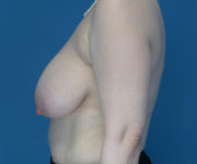 before breast reduction left side view case 3867 | Crispin Plastic Surgery Atlanta, GA