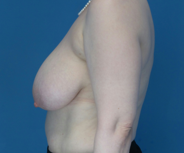before breast reduction left side view case 3867 | Crispin Plastic Surgery Atlanta, GA