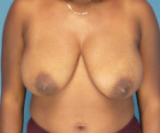 before breast reduction front view case 3872
