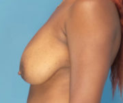 before breast reduction left side view case 3872