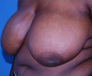 before breast reduction front left diagonal view case 4781 | Crispin Plastic Surgery Atlanta, GA