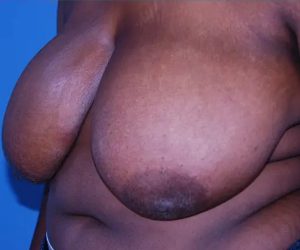 before breast reduction front left diagonal view case 4781 | Crispin Plastic Surgery Atlanta, GA
