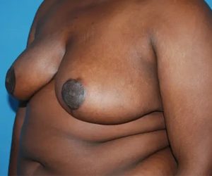 after breast reduction surgery front left diagonal view case 4781 | Crispin Plastic Surgery Atlanta, GA