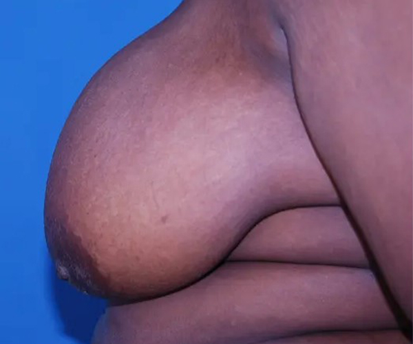 before breast reduction surgery left side view case 4781 | Crispin Plastic Surgery Atlanta, GA