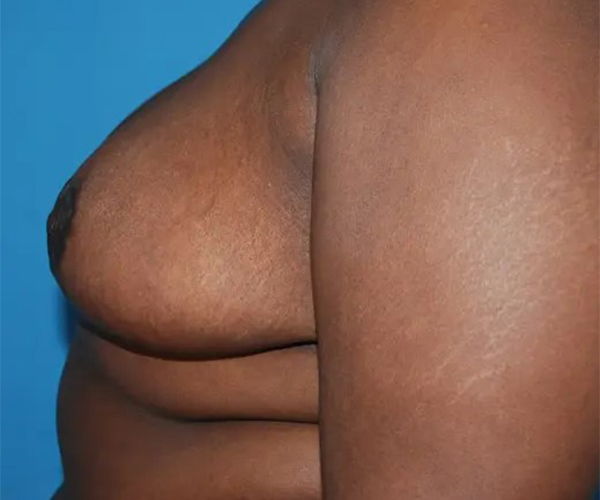 after breast reduction surgery left side view case 4781 | Crispin Plastic Surgery Atlanta, GA