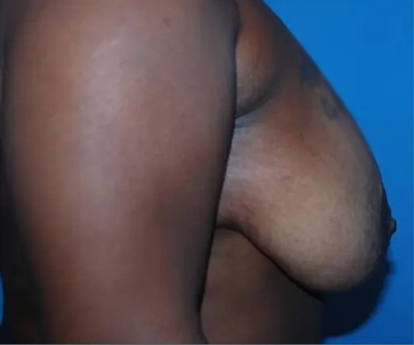 before breast reduction surgery right side view case 4786 | Crispin Plastic Surgery Atlanta, GA