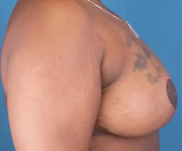 after breast reduction surgery right side view case 4786 | Crispin Plastic Surgery Atlanta, GA