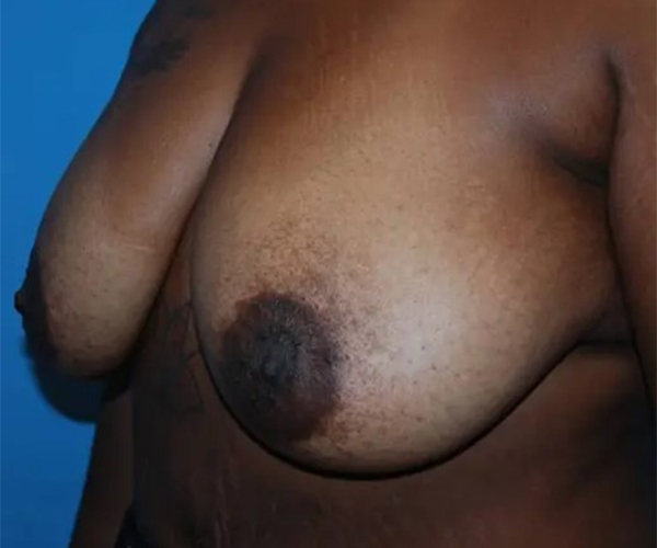 before breast reduction surgery front left angle view case 4786 | Crispin Plastic Surgery Atlanta, GA