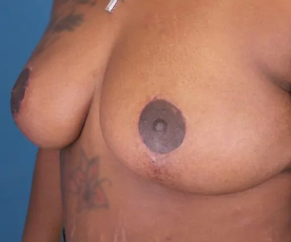 after breast reduction surgery front left angle view case 4786 | Crispin Plastic Surgery Atlanta, GA