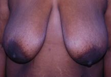 before breast reduction front view case 4796 | Crispin Plastic Surgery Atlanta, GA