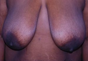 before breast reduction front view case 4796 | Crispin Plastic Surgery Atlanta, GA