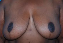 after breast reduction front view case 4796 | Crispin Plastic Surgery Atlanta, GA