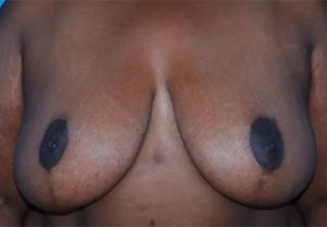 after breast reduction front view case 4796 | Crispin Plastic Surgery Atlanta, GA