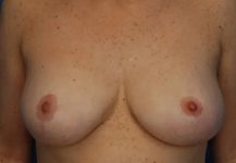 after breast reduction front view case 4801 | Crispin Plastic Surgery Atlanta, GA