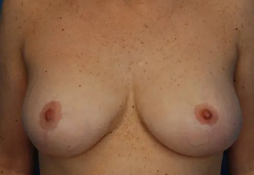 after breast reduction front view case 4801 | Crispin Plastic Surgery Atlanta, GA
