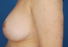 after breast reduction surgery left side view case 4801 | Crispin Plastic Surgery Atlanta, GA