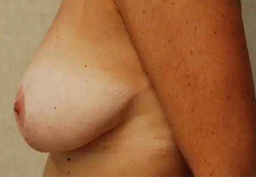 before breast reduction left side view case 4801 | Crispin Plastic Surgery Atlanta, GA