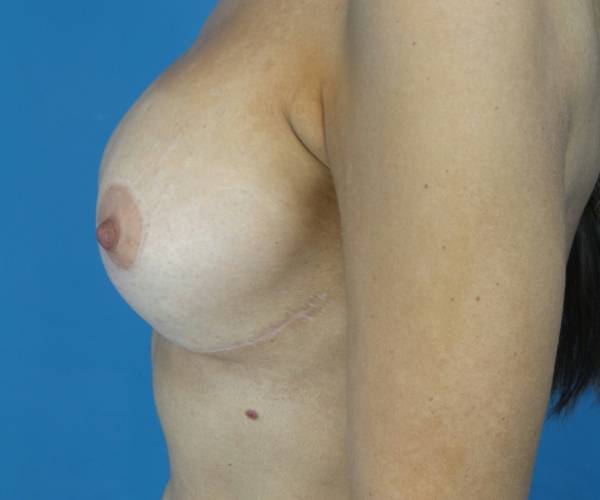 after breast revision left side view case 3402