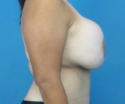 before breast revision right side view case 3413