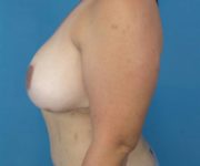 after breast revision left side view case 3413