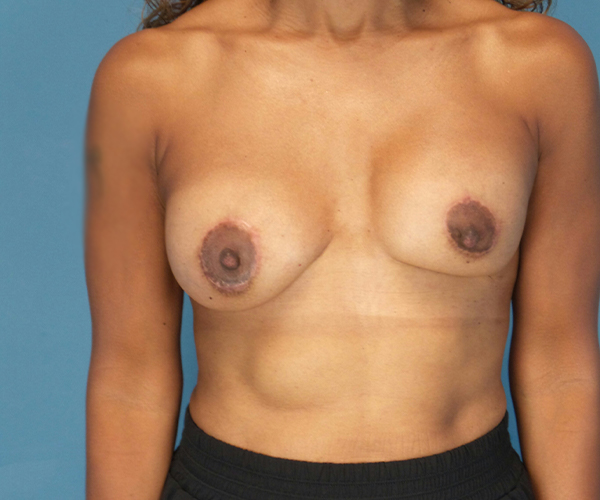 before breast revision surgery front view case 4863 | Crispin Plastic Surgery Atlanta, GA