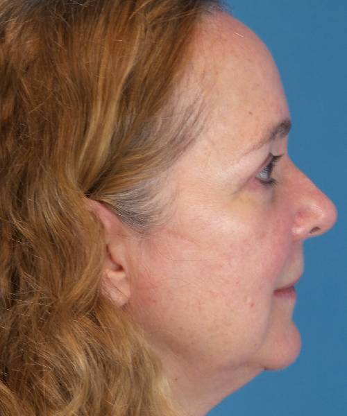 After Eyelid Lift Female Patient Right Side Angle View Case 1461