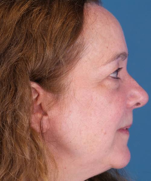 Before Eyelid Lift Female Patient Right Side Angle View Case 1461