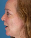 After Eyelid Lift Female Patient Left Side Angle View Case 1461