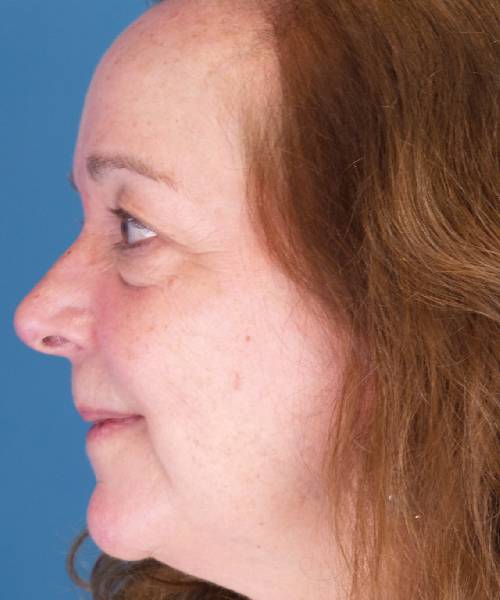 Before Eyelid Lift Female Patient Left Side Angle View Case 1461