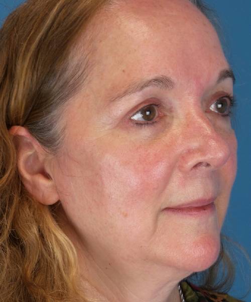 After Eyelid Lift Female Patient Right Angle View Case 1461