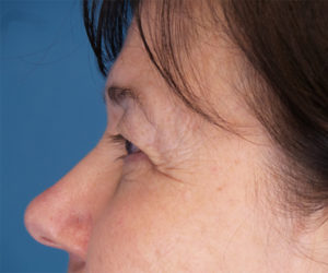 before eyelid lift female patient left side view case 1508
