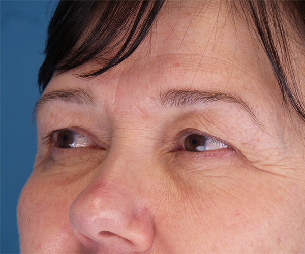 before eyelid lift female patient left angle view case 1508