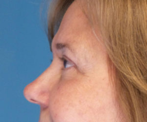after eyelid lift female patient left side view case 1508