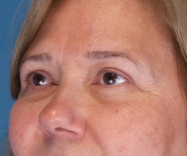 after eyelid lift female patient left angle view case 1508