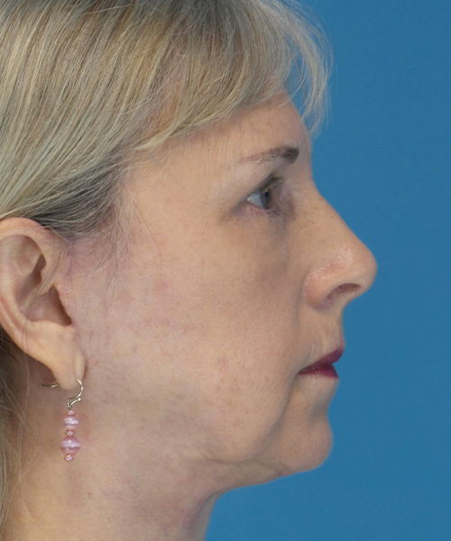 after eyelid lift female patient right side view case 2579