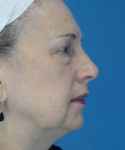 before eyelid lift female patient right side view case 2579