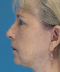after eyelid lift female patient left side view case 2579
