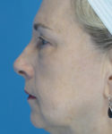 before eyelid lift female patient left side view case 2579