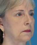 after eyelid lift female patient right angle view case 2579