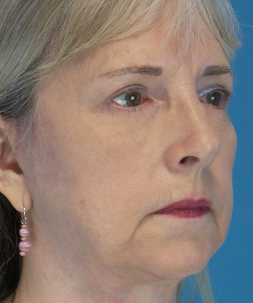 after eyelid lift female patient right angle view case 2579