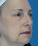 before eyelid lift female patient right angle view case 2579