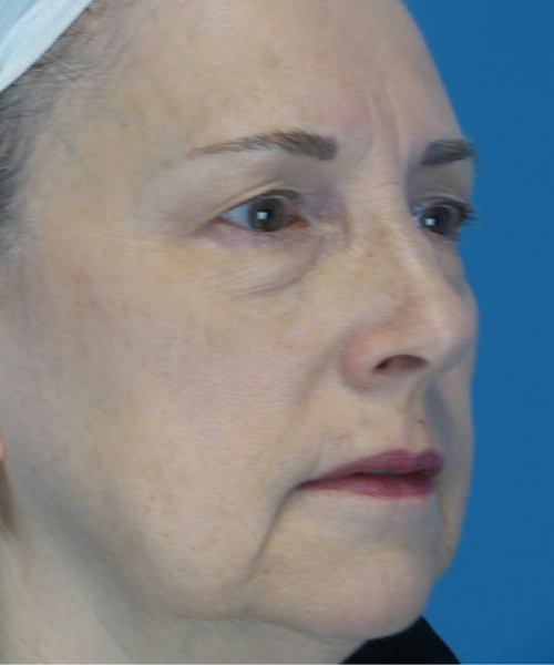 before eyelid lift female patient right angle view case 2579