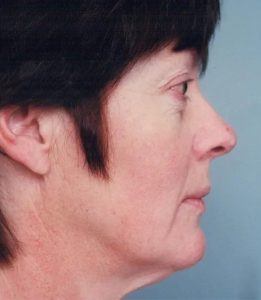 before eyelid lift surgery female patient right side view case 4887 Crispin Plastic Surgery Atlanta, GA
