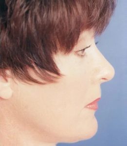before eyelid lift surgery female patient right side view case 4887 Crispin Plastic Surgery Atlanta, GA
