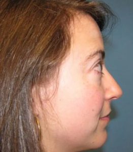 before eyelid lift surgery female patient right side view case 4893 Crispin Plastic Surgery Atlanta, GA
