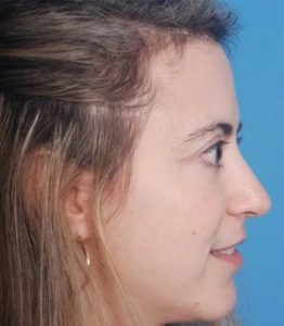 after eyelid lift surgery female patient right side view case 4893 Crispin Plastic Surgery Atlanta, GA