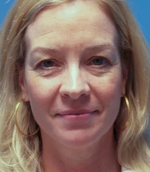 before eyelid lift surgery female patient front view Crispin Plastic Surgery Atlanta, GA