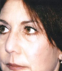 before eyelid lift surgery front diagonal view case 4899 Crispin Plastic Surgery Atlanta, GA