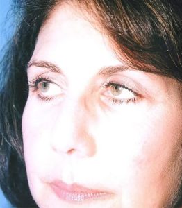 after eyelid lift front diagonal view case 4899 Crispin Plastic Surgery Atlanta, GA