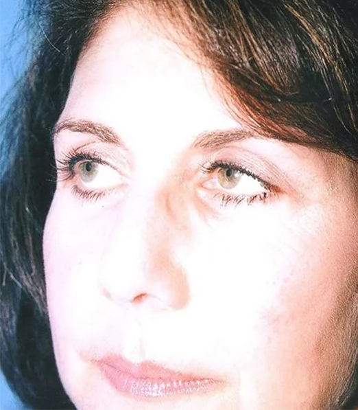 after eyelid lift front diagonal view case 4899 Crispin Plastic Surgery Atlanta, GA